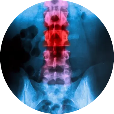 Herniated or Bulging Discs