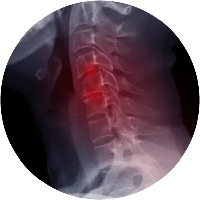 Spinal Stenosis